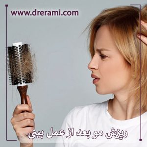 ریزش مو بعد از عمل بینی _ دکتر محمد ارمی