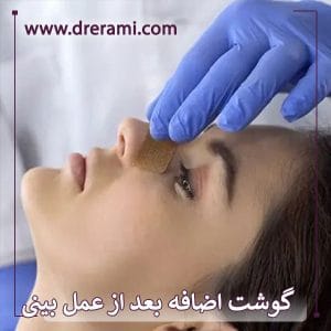 گوشت اضافه بعد از عمل بینی _ دکتر محمد ارمی