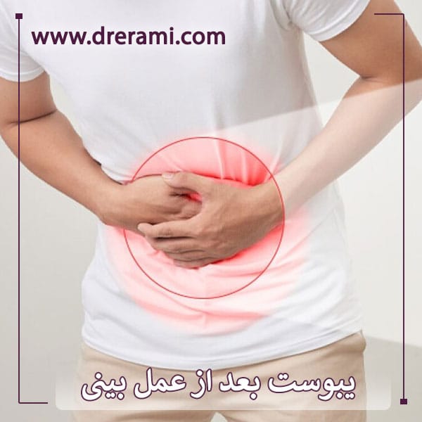 یبوست بعد از عمل بینی _ دکتر محمد ارمی