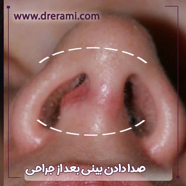 صدا دادن بعد از جراحی بینی