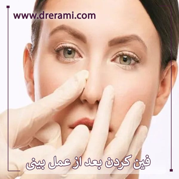 فین کردن بعد از عمل بینی _ دکتر محمد ارمی