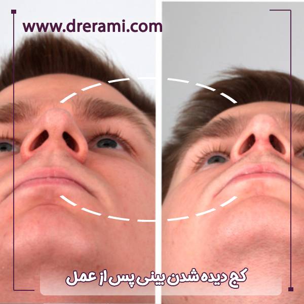 کج دیده شدن بینی بعد از جراحی