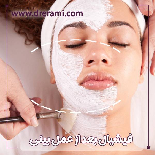 فیشیال بعد از عمل بینی