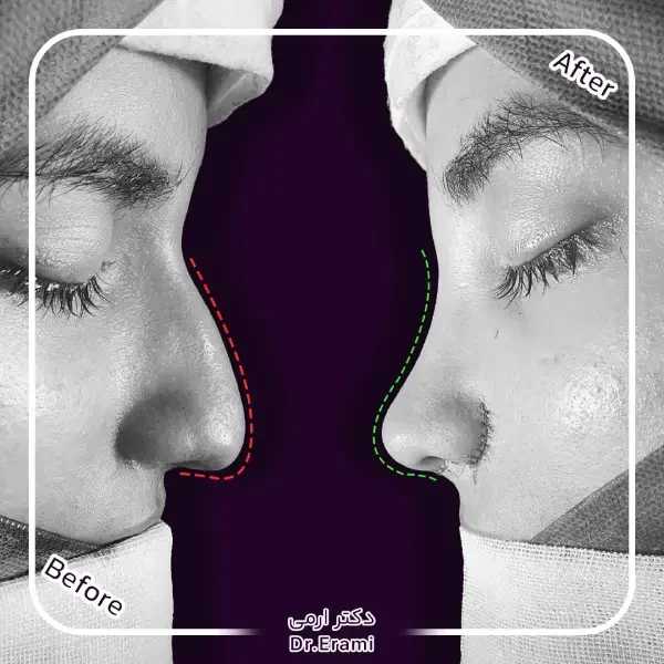 rhinoplasty 16 عمل بینی _ دکتر محمد ارمی